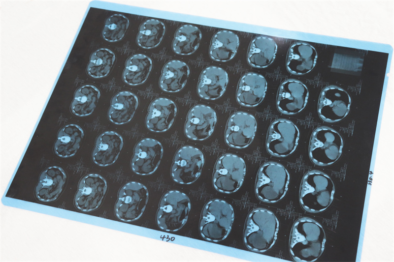 M41B 瓷白激光（双面）-B超片